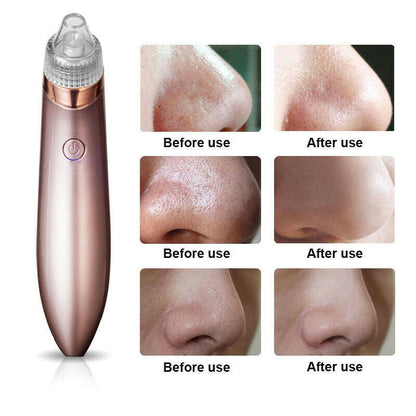 Acne Pimple Remover Strong Suction Tool